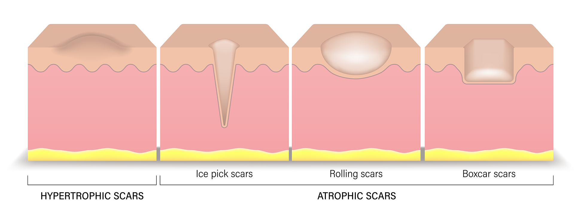 Acne scars alt text